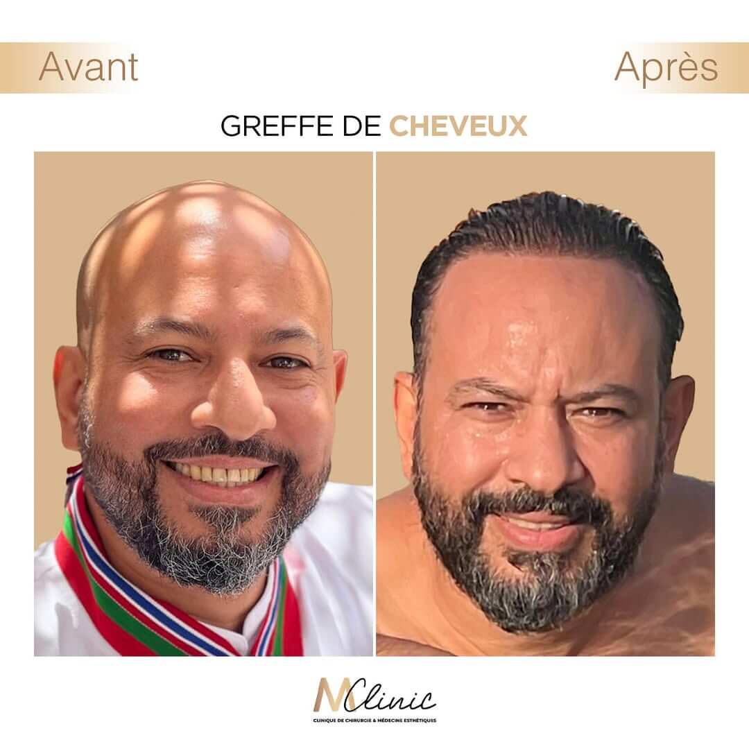 Hair Transplant in Marrakech, Morocco by Mclinic Marrakesh