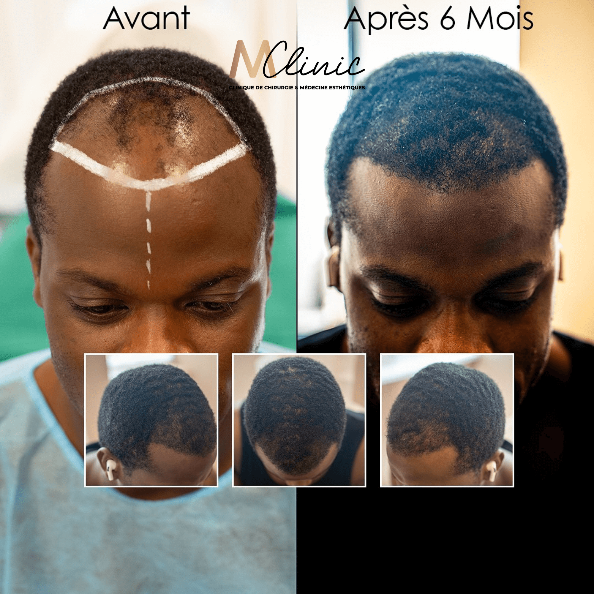 Hair Transplant in Marrakech, Morocco by Mclinic Marrakesh