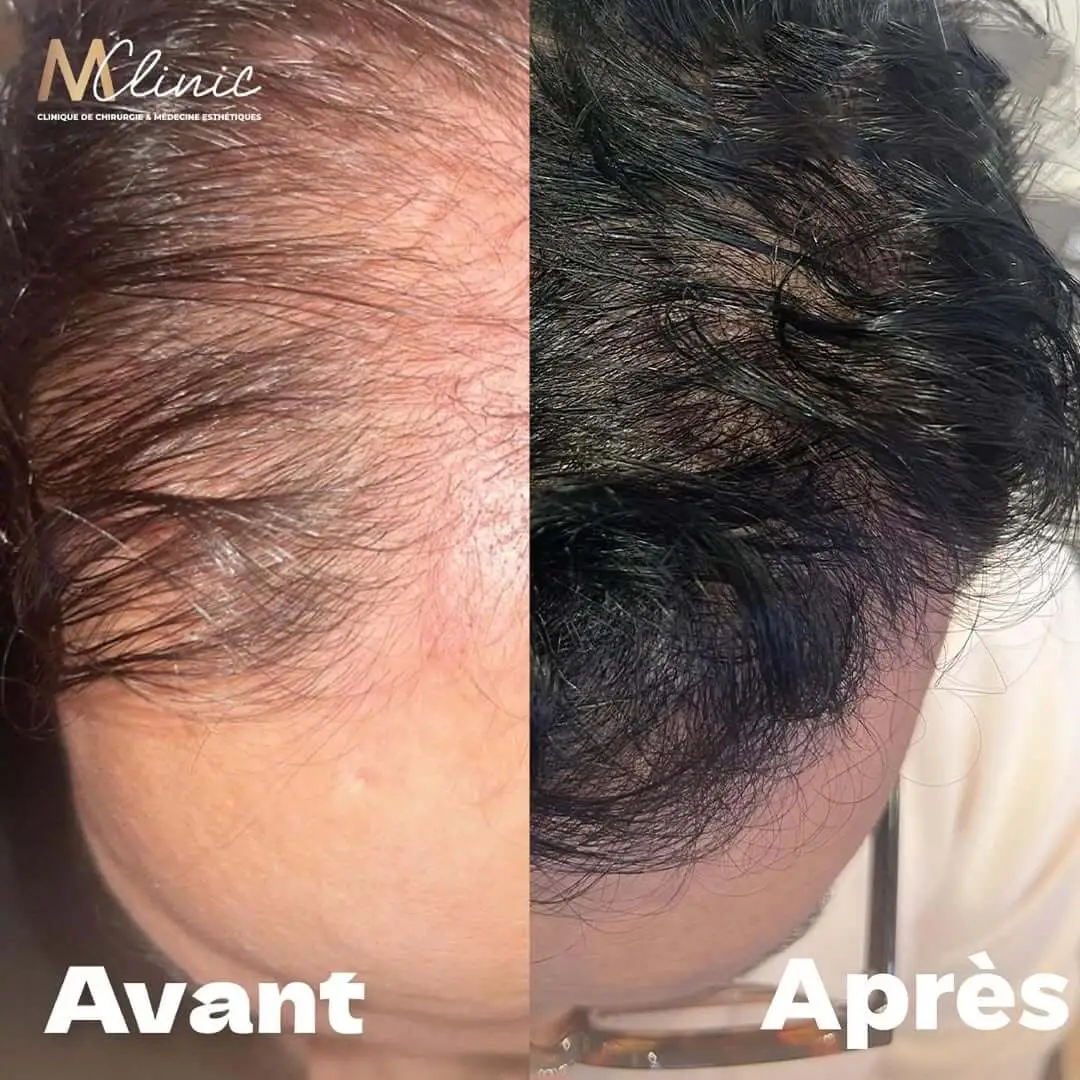 Hair Transplant in Marrakech, Morocco by Mclinic Marrakesh