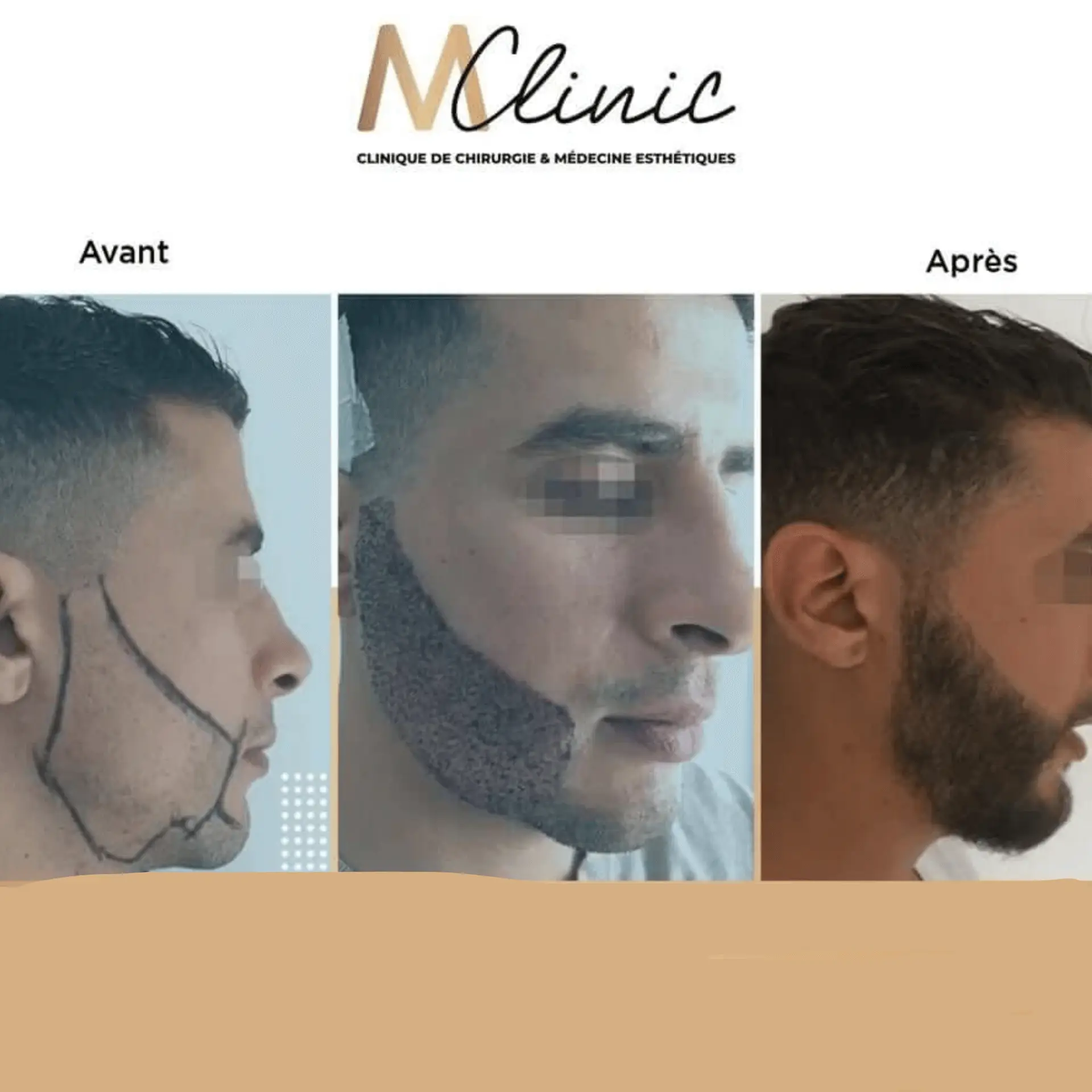 Beard Transplant in Marrakech, Morocco by Mclinic Marrakesh