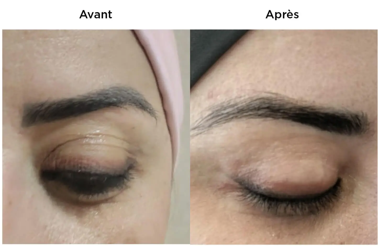Blepharoplasty in Marrakech, Morocco by Mclinic Marrakesh