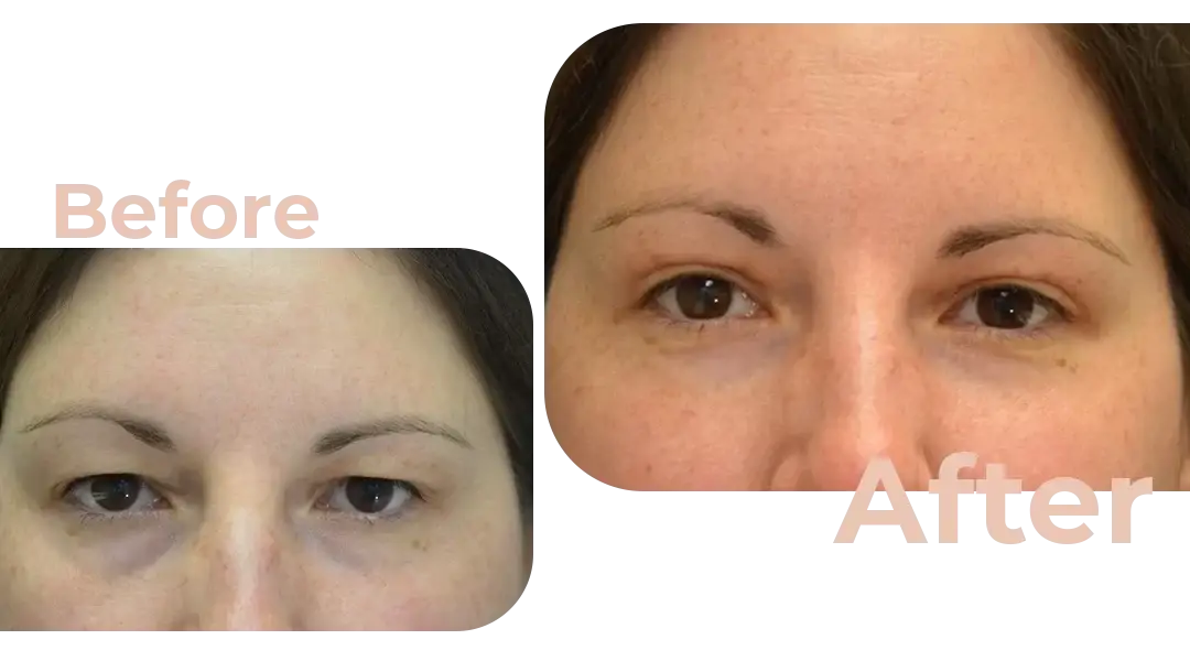 Eyelid Surgery (Blepharoplasty) in Istanbul, Turkey by Avicenna Hospital