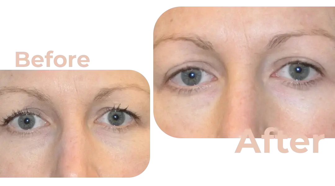 Eyelid Surgery (Blepharoplasty) in Istanbul, Turkey by Avicenna Hospital