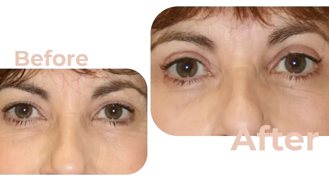 Eyelid Surgery (Blepharoplasty) in Istanbul, Turkey by Avicenna Hospital