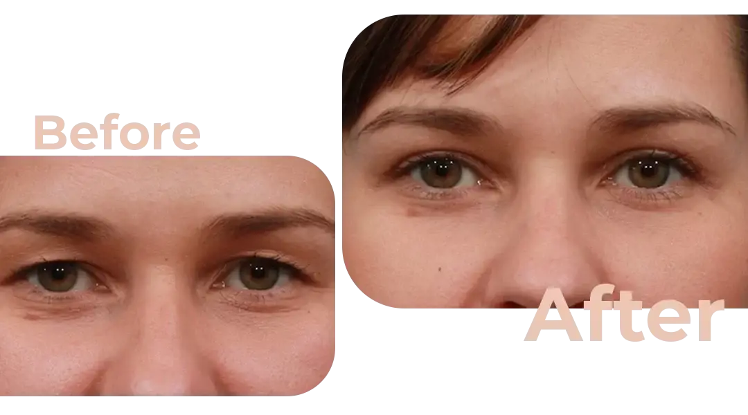 Eyelid Surgery (Blepharoplasty) in Istanbul, Turkey by Avicenna Hospital