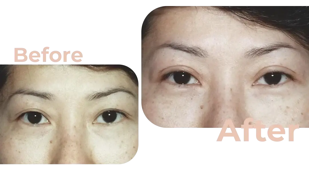 Eyelid Surgery (Blepharoplasty) in Istanbul, Turkey by Avicenna Hospital