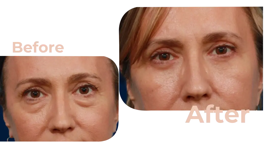 Eyelid Surgery (Blepharoplasty) in Istanbul, Turkey by Avicenna Hospital