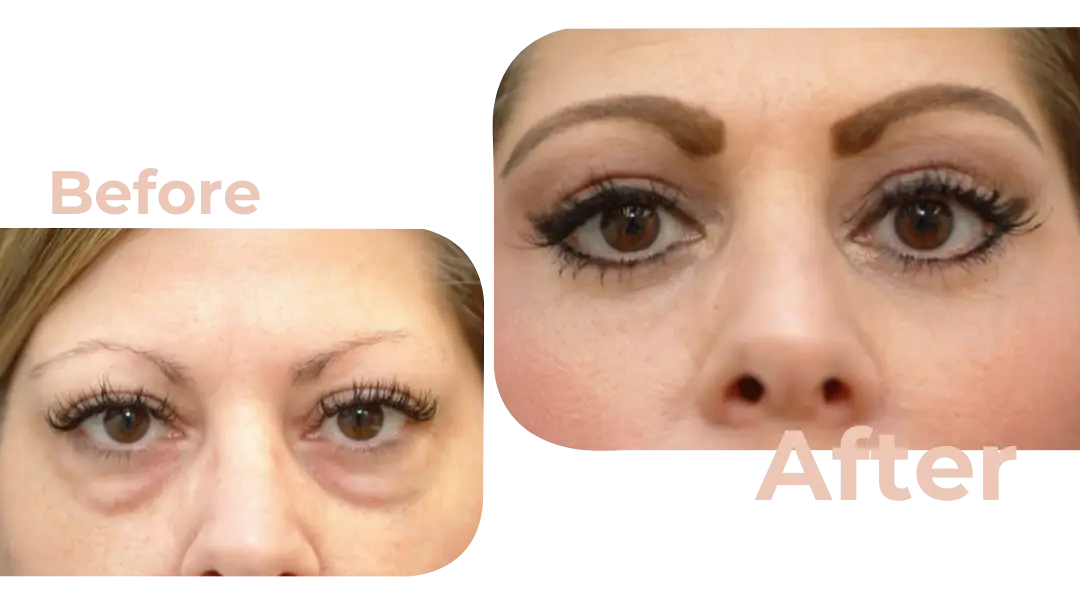 Eyelid Surgery (Blepharoplasty) in Istanbul, Turkey by Avicenna Hospital