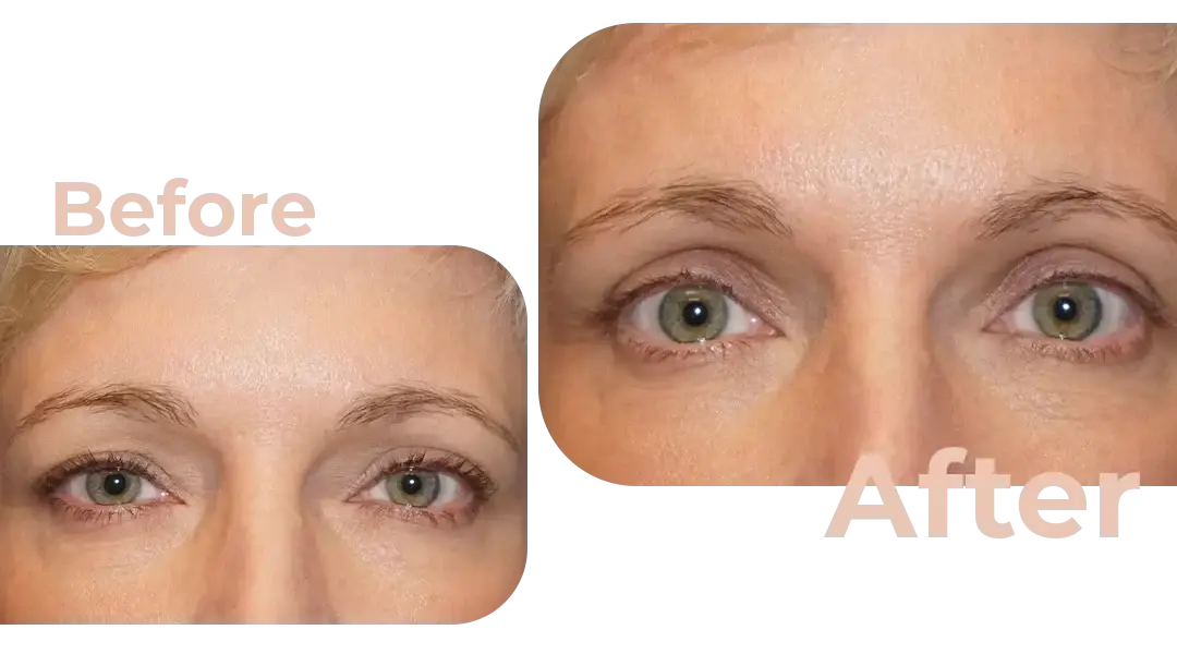 Eyelid Surgery (Blepharoplasty) in Istanbul, Turkey by Avicenna Hospital