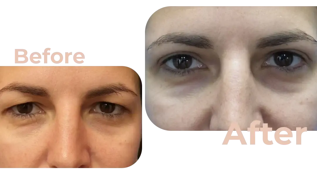 Eyelid Surgery (Blepharoplasty) in Istanbul, Turkey by Avicenna Hospital