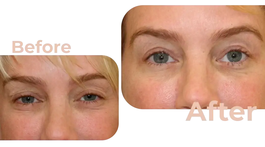 Eyelid Surgery (Blepharoplasty) in Istanbul, Turkey by Avicenna Hospital