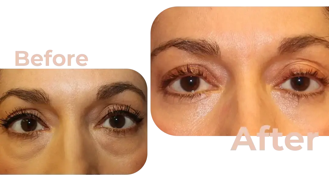 Eyelid Surgery (Blepharoplasty) in Istanbul, Turkey by Avicenna Hospital