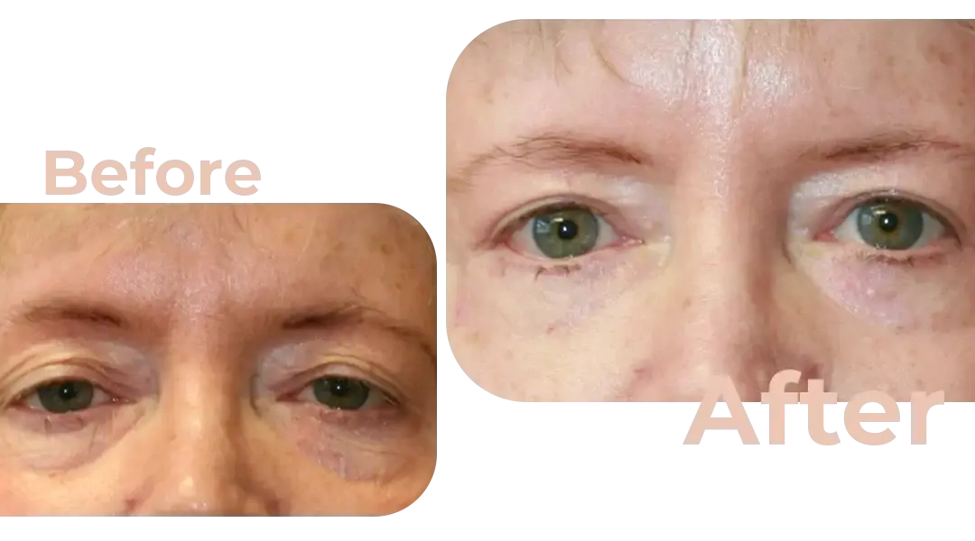 Eyelid Surgery (Blepharoplasty) in Istanbul, Turkey by Avicenna Hospital