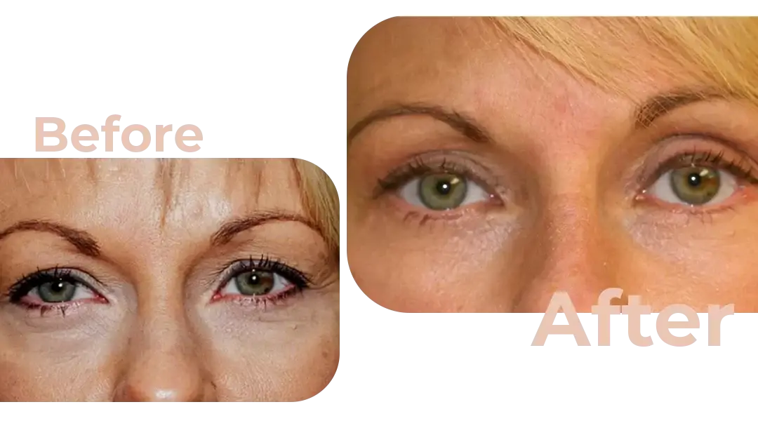 Eyelid Surgery (Blepharoplasty) in Istanbul, Turkey by Avicenna Hospital