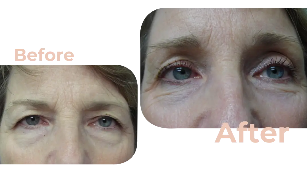 Eyelid Surgery (Blepharoplasty) in Istanbul, Turkey by Avicenna Hospital