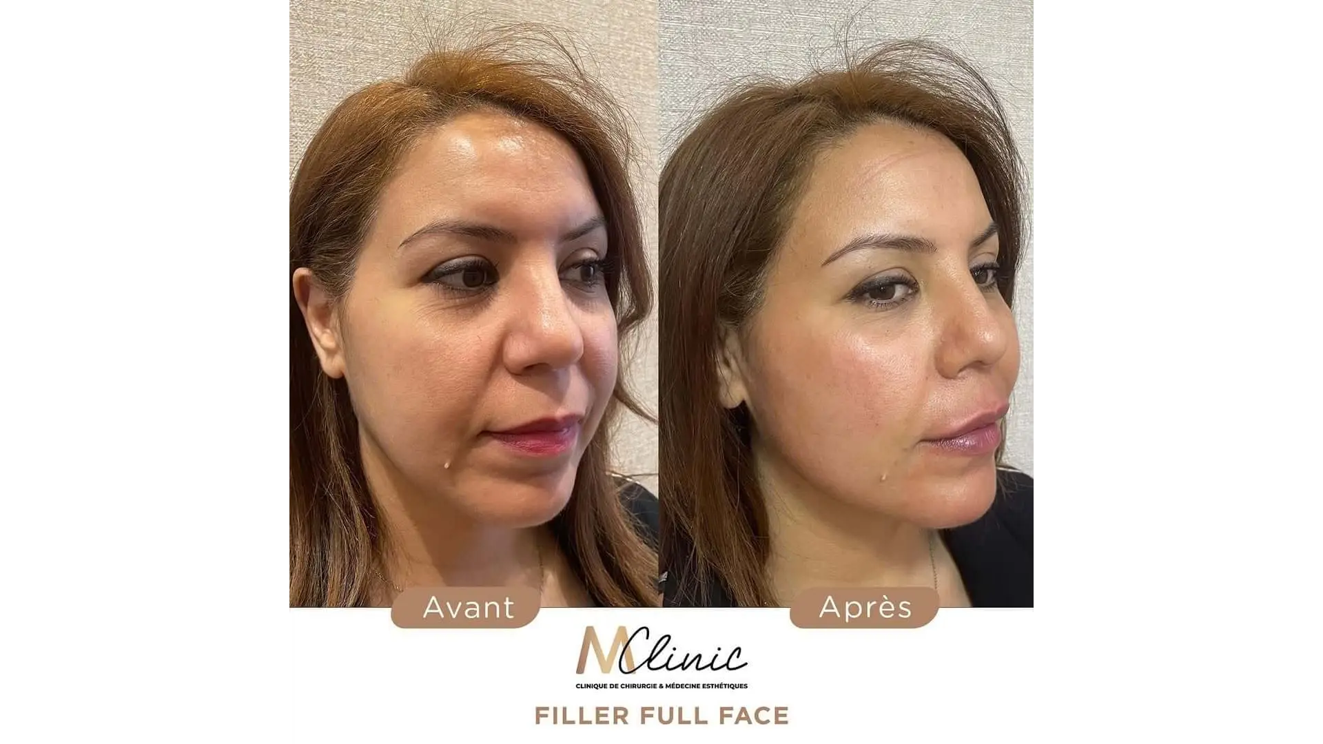 Facial Lipofilling in Marrakech, Morocco by Mclinic Marrakesh