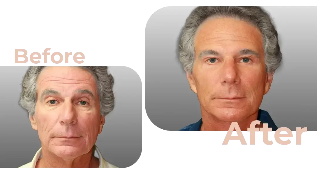 Facelift in Istanbul, Turkey by Avicenna Hospital