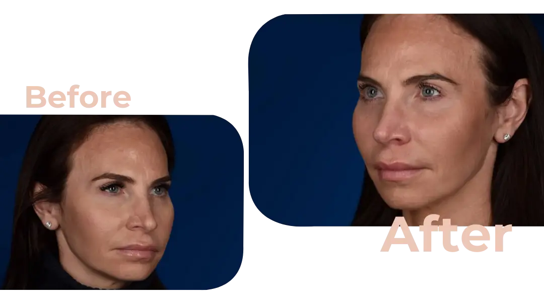 Facelift in Istanbul, Turkey by Avicenna Hospital