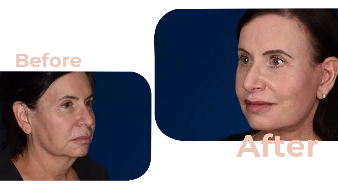 Facelift in Istanbul, Turkey by Avicenna Hospital