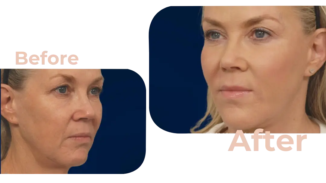 Facelift in Istanbul, Turkey by Avicenna Hospital
