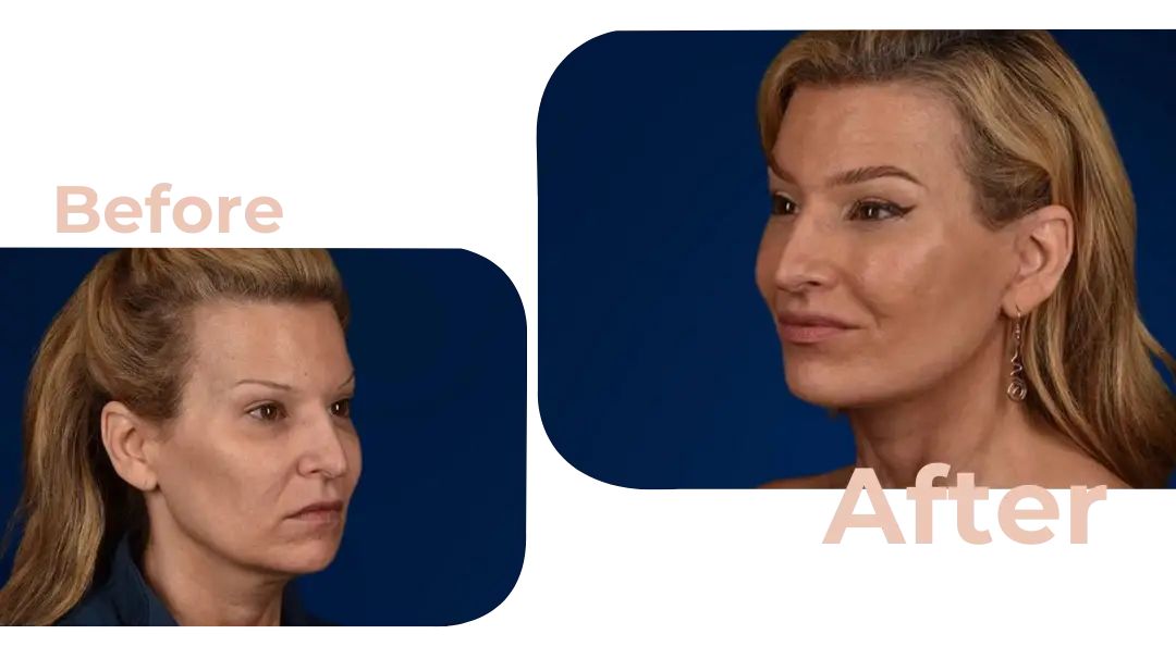 Facelift in Istanbul, Turkey by Avicenna Hospital
