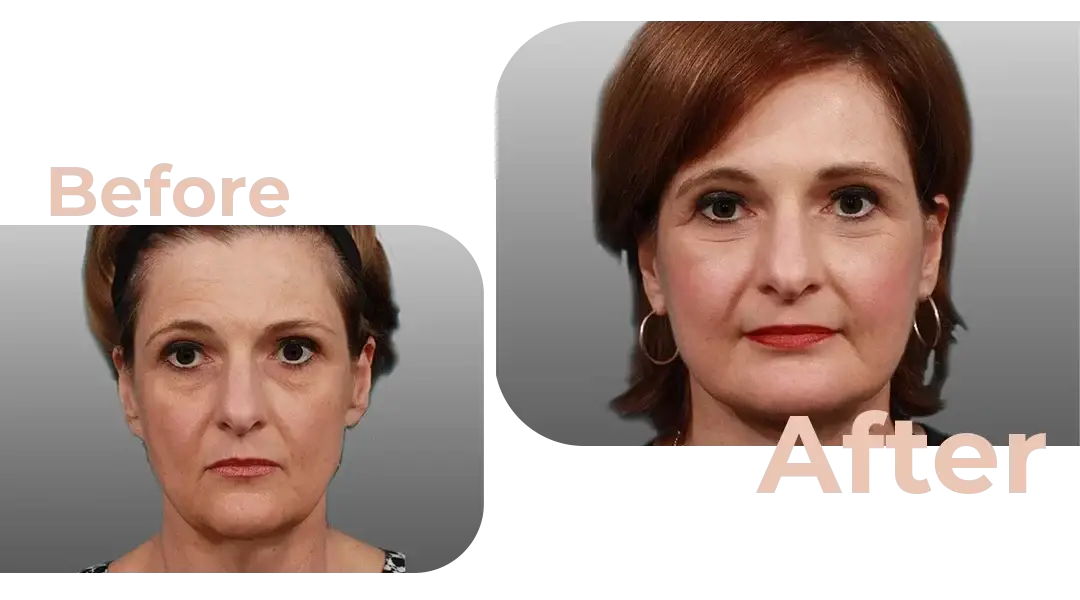 Facelift in Istanbul, Turkey by Avicenna Hospital