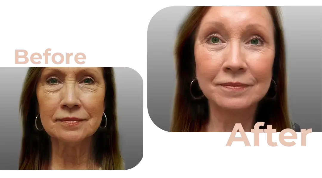 Facelift in Istanbul, Turkey by Avicenna Hospital
