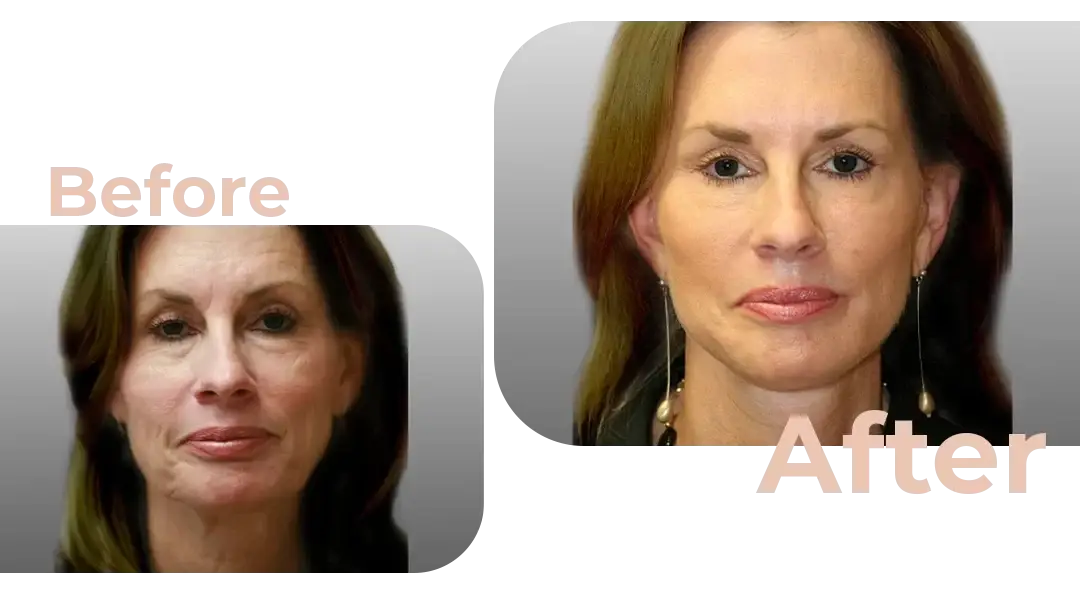 Facelift in Istanbul, Turkey by Avicenna Hospital