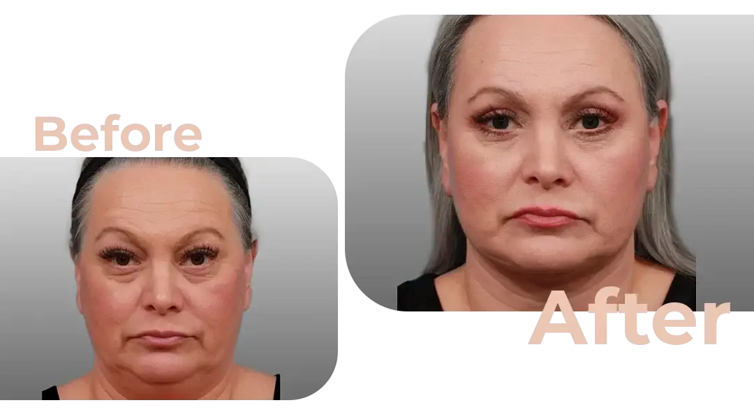 Facelift in Istanbul, Turkey by Avicenna Hospital