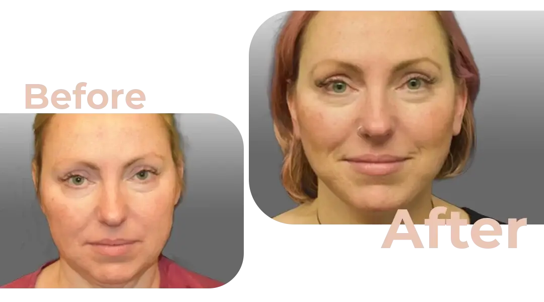 Facelift in Istanbul, Turkey by Avicenna Hospital