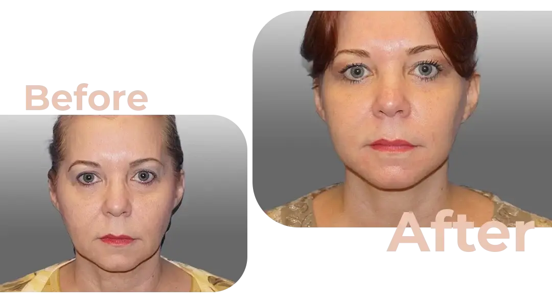 Facelift in Istanbul, Turkey by Avicenna Hospital
