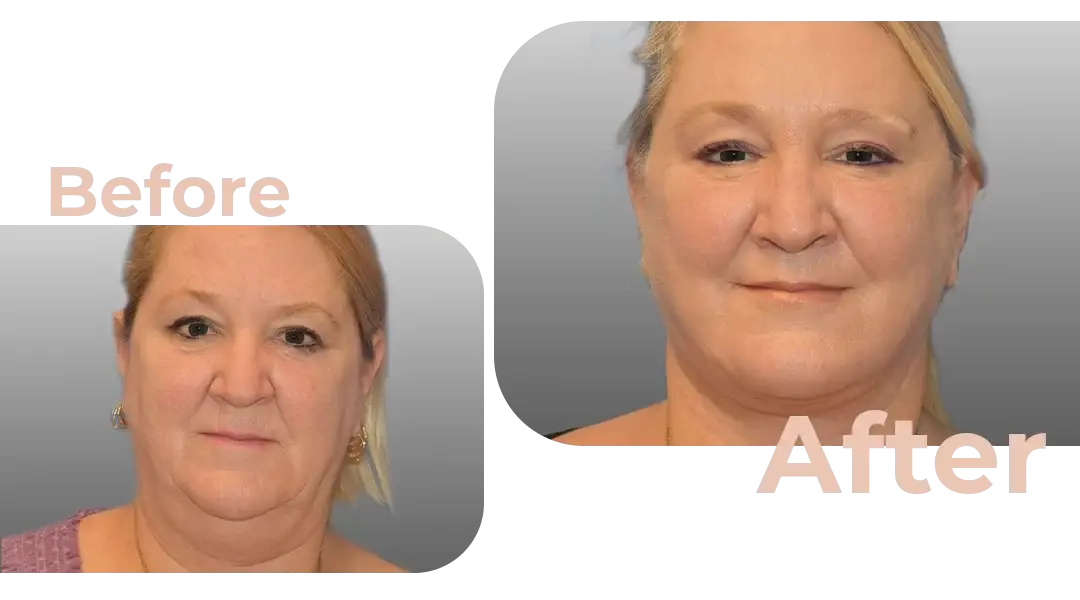 Facelift in Istanbul, Turkey by Avicenna Hospital