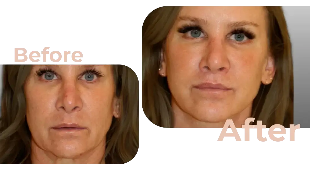 Facelift in Istanbul, Turkey by Avicenna Hospital