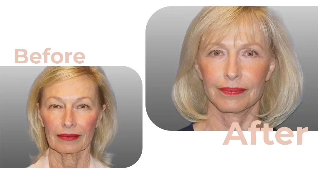 Facelift in Istanbul, Turkey by Avicenna Hospital