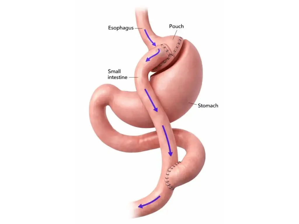 Gastric Bypass Surgery in Istanbul, Turkey by Avicenna Hospital — Weight Loss Surgery Procedure in Turkey