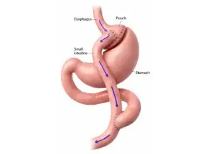 Gastric Bypass Surgery in Istanbul, Turkey by Avicenna Hospital at Avicenna Hospital — Weight Loss Surgery Procedure Abroad