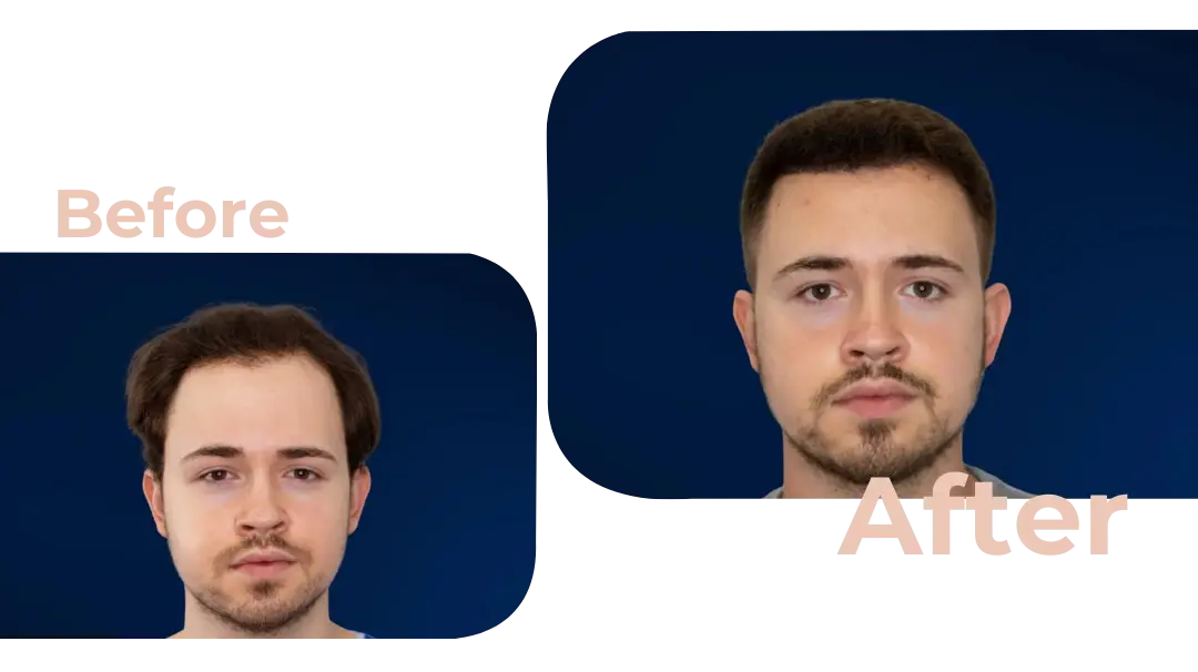 FUE Hair Transplant in Istanbul, Turkey by Avicenna Hospital