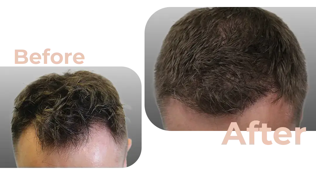 FUE Hair Transplant in Istanbul, Turkey by Avicenna Hospital