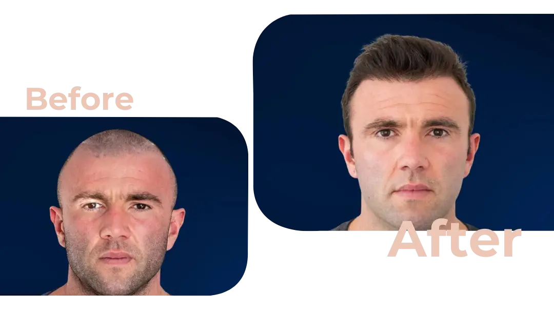 FUE Hair Transplant in Istanbul, Turkey by Avicenna Hospital