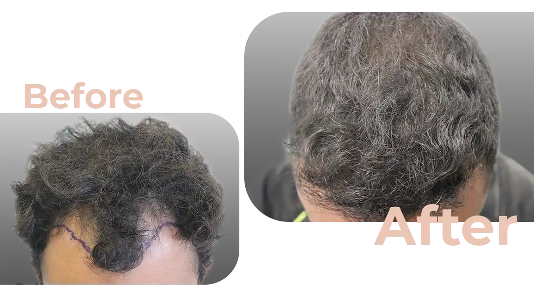 FUE Hair Transplant in Istanbul, Turkey by Avicenna Hospital