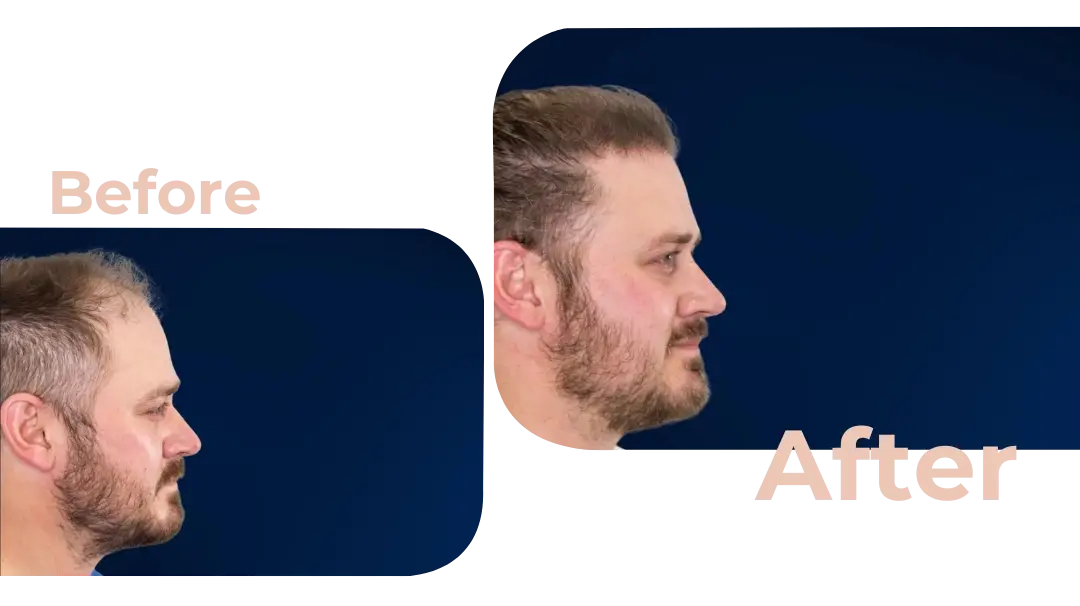 FUE Hair Transplant in Istanbul, Turkey by Avicenna Hospital