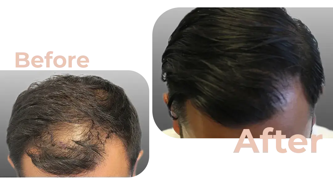 FUE Hair Transplant in Istanbul, Turkey by Avicenna Hospital