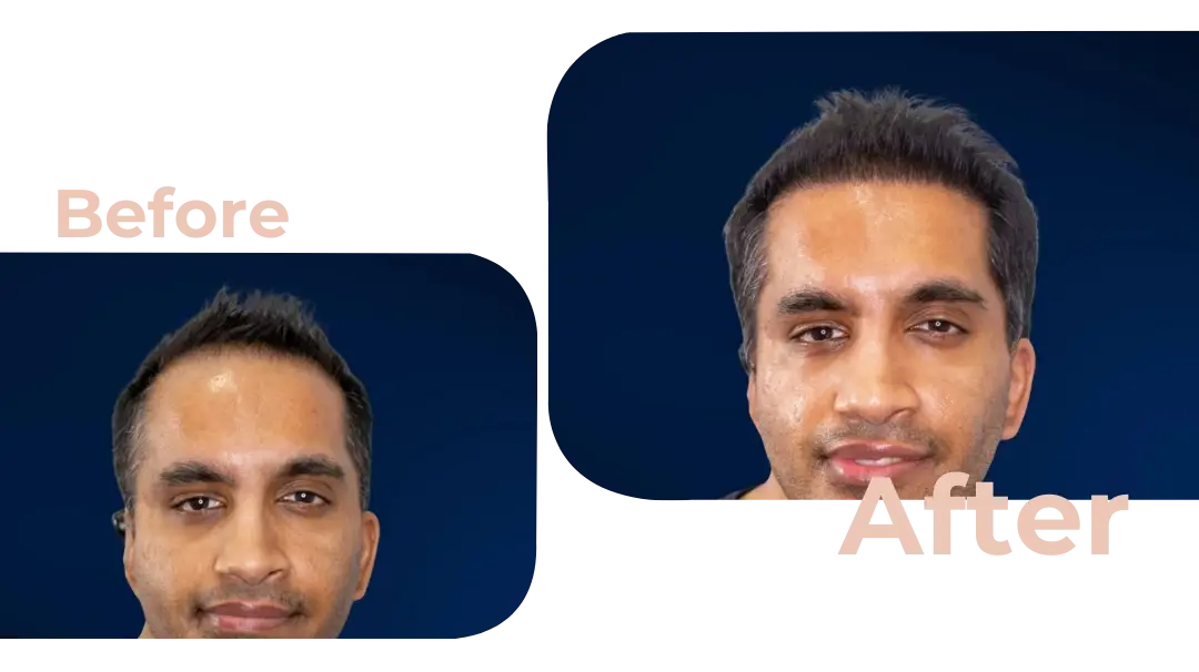 FUE Hair Transplant in Istanbul, Turkey by Avicenna Hospital
