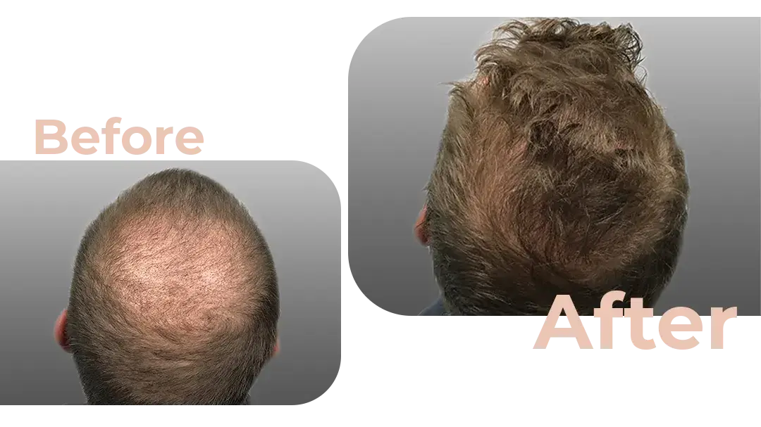FUE Hair Transplant in Istanbul, Turkey by Avicenna Hospital