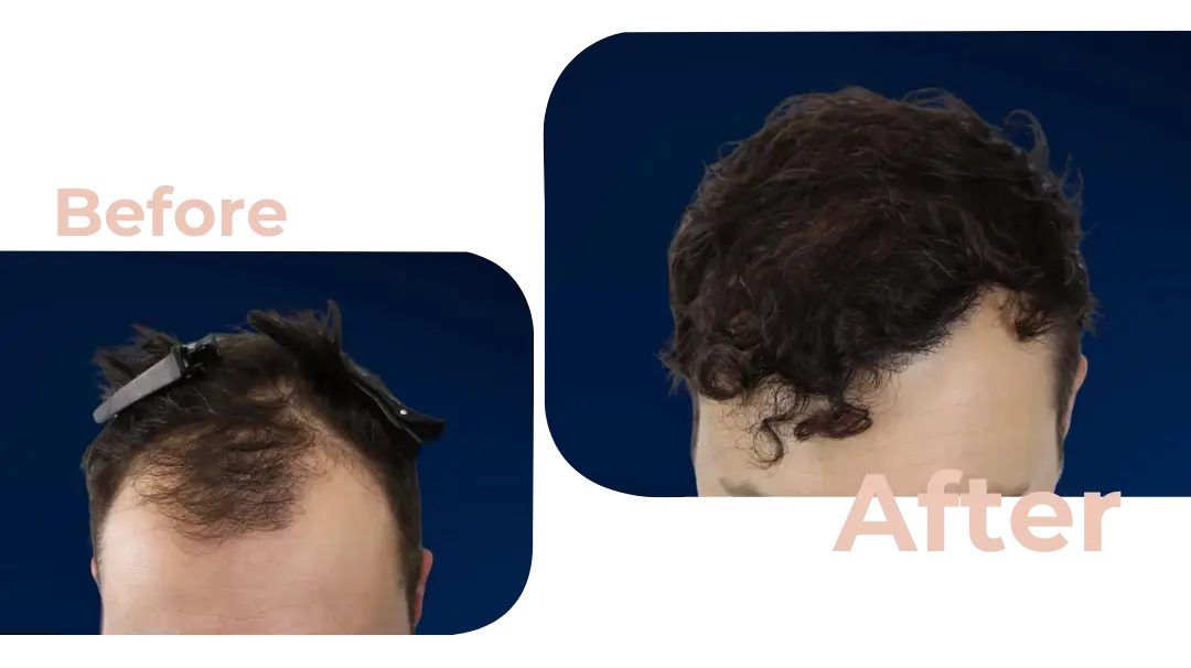 FUE Hair Transplant in Istanbul, Turkey by Avicenna Hospital
