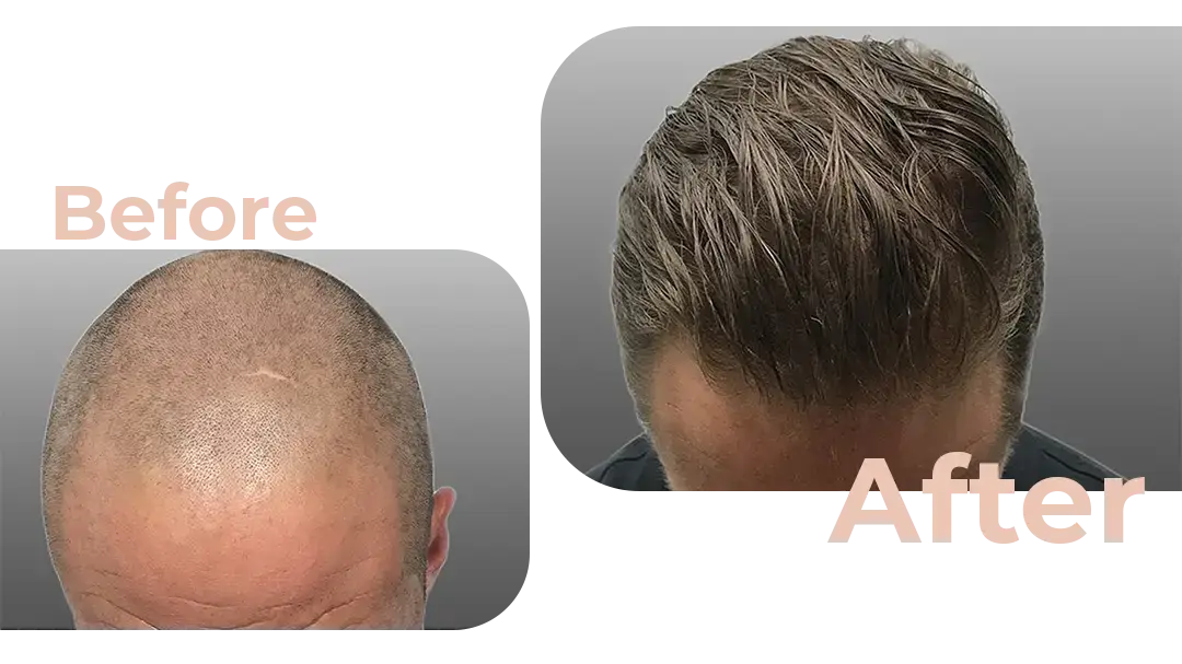 FUE Hair Transplant in Istanbul, Turkey by Avicenna Hospital