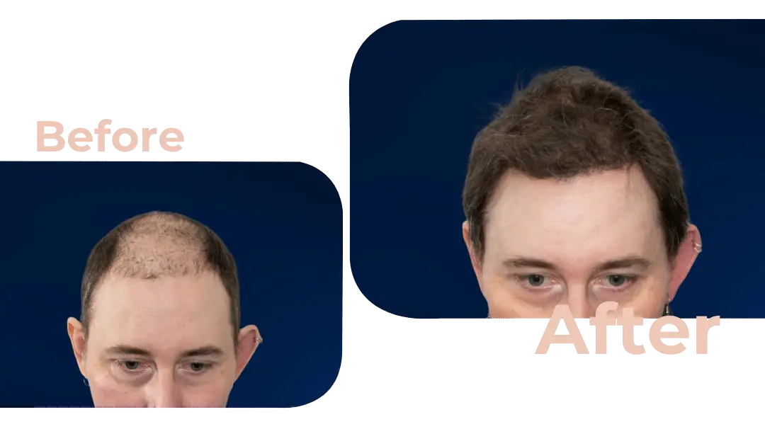 FUE Hair Transplant in Istanbul, Turkey by Avicenna Hospital