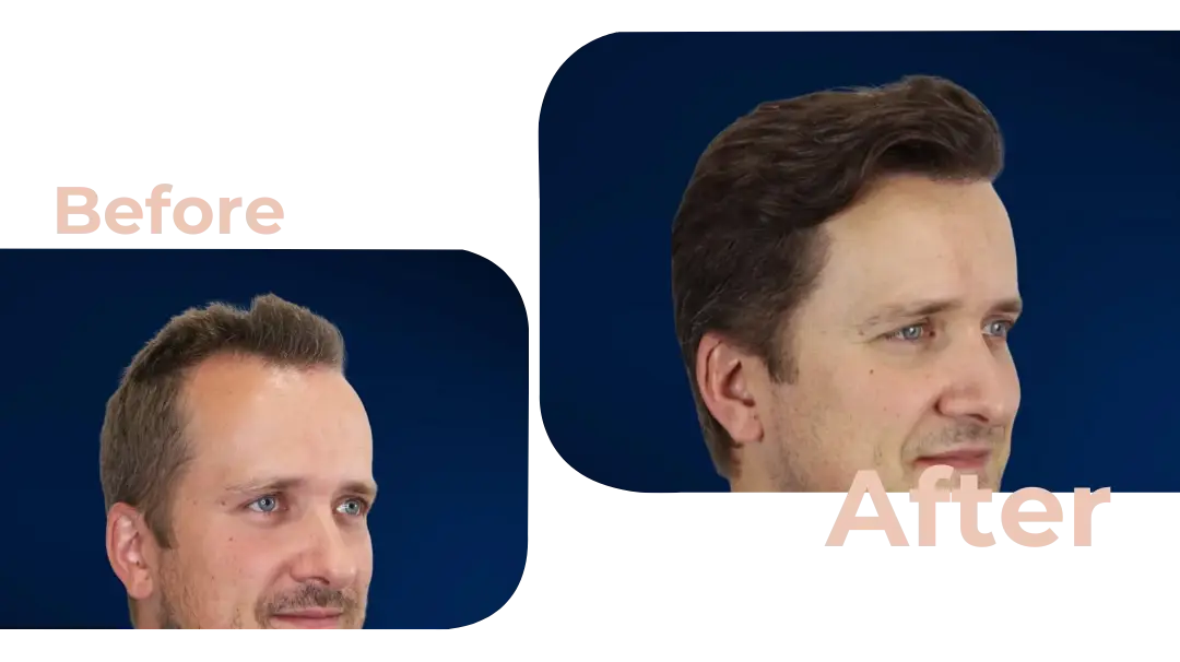 FUE Hair Transplant in Istanbul, Turkey by Avicenna Hospital