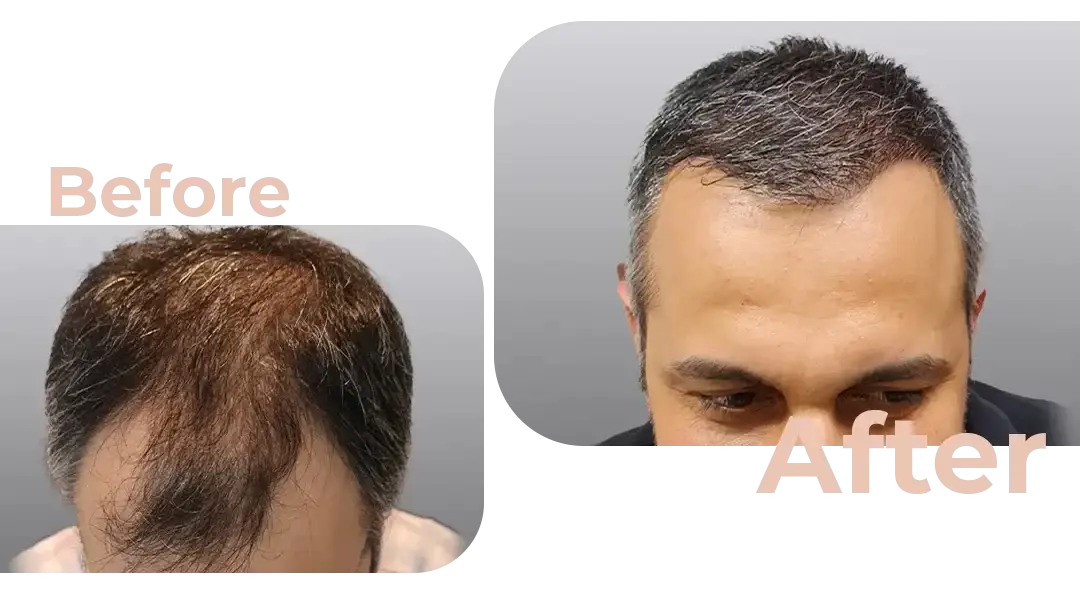 FUE Hair Transplant in Istanbul, Turkey by Avicenna Hospital