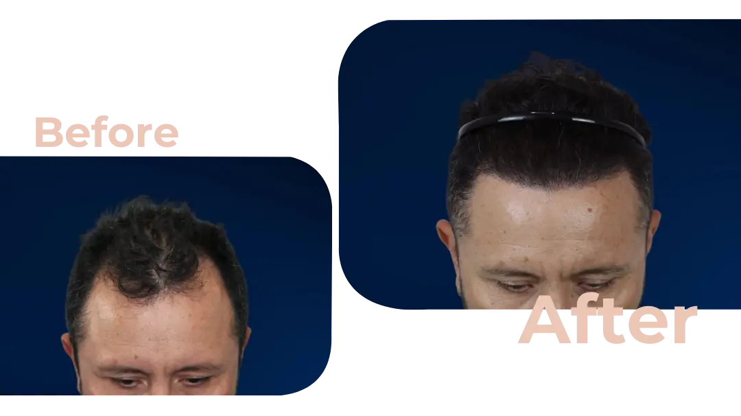 FUE Hair Transplant in Istanbul, Turkey by Avicenna Hospital